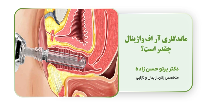ماندگاری آر اف واژینال چقدر است؟