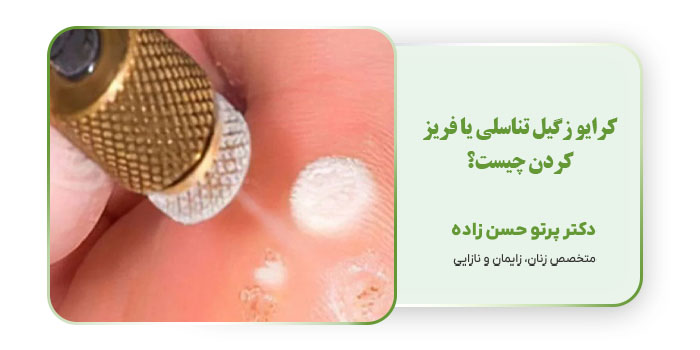 کرایو زگیل تناسلی یا فریز کردن چیست؟